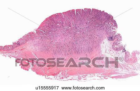 Stock Photo - Close up of invasive colon cancer cells. Fotosearch