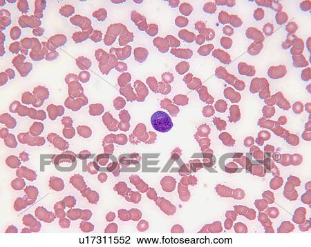 Stock Image - Close up of myelogenous leukemia cells. Fotosearch