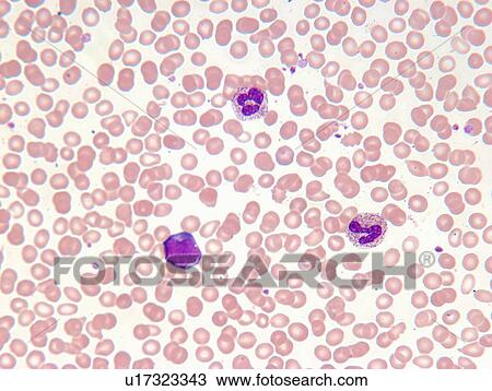 Stock Image - Close up of myelogenous leukemia cells. Fotosearch