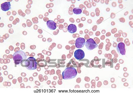 Stock Photo - Close up of myelogenous leukemia cells. Fotosearch