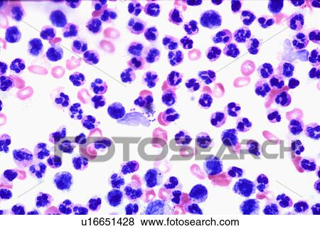 Stock Photo - Fluid aspirate from staph infection. Fotosearch