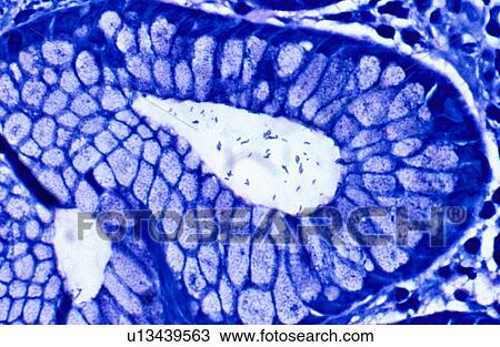 Stock Image - Helicobacter pylori in antral crypt. Fotosearch