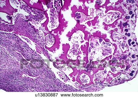 Infected cells of bone plate View Large Photo Image Stock Photo - Infected cells of bone plate. Fotosearch