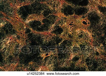 Picture - Liver cirrhosis cells. Fotosearch