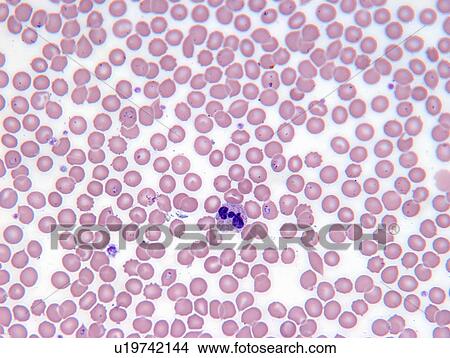 Picture - Malarial blood cells. Fotosearch