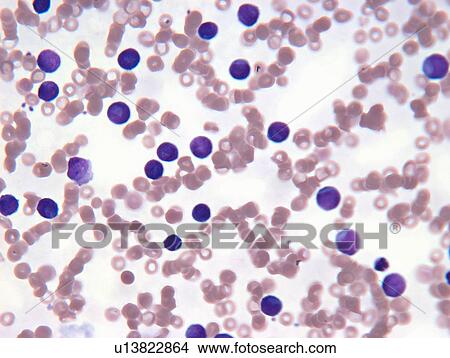 Picture - Neoplastic lymphocyte cells in blood. Fotosearch