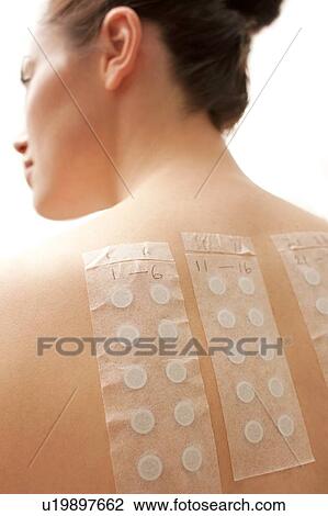 Stock Image - Allergy patch test.. Fotosearch