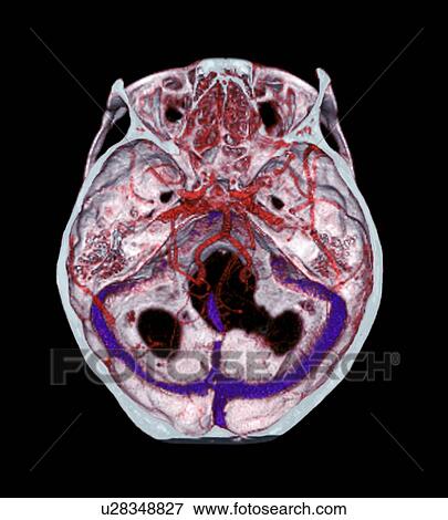 Arteries of the brain. 3D computed tomography (CT) scan of normal arteries in the brain of a 35 year old. View Large Photo Image Stock Photo - Arteries of the brain. 3D computed tomography (CT) scan of normal arteries in the brain of a 35 year old.. Fotosearch