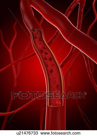 Stock Image - Artery. Cut-away computer artwork showing erythrocytes (red blood cells) in an artery.. Fotosearch