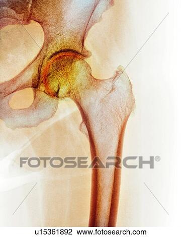 Stock Image - Arthritis of the hip. Coloured X-ray of an arthritic hip.. Fotosearch
