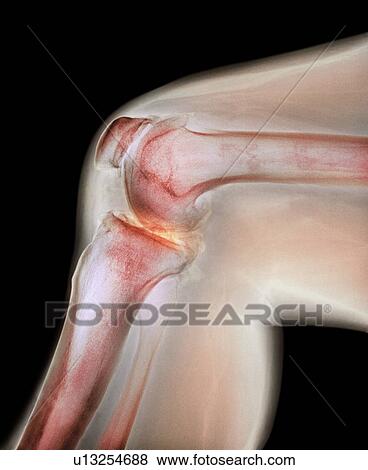 Arthritis of the knee. Coloured X-ray the arthritic knee of a 37 year old man. The knee had previously been damaged in a motorbike accident. View Large Photo Image Stock Photo - Arthritis of the knee. Coloured X-ray the arthritic knee of a 37 year old man. The knee had previously been damaged in a motorbike accident.. Fotosearch