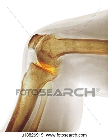 Arthritis of the knee. Coloured X-ray the arthritic knee of a 37 year old man. The knee had previously been damaged in a motorbike accident. View Large Photo Image Stock Photo - Arthritis of the knee. Coloured X-ray the arthritic knee of a 37 year old man. The knee had previously been damaged in a motorbike accident.. Fotosearch
