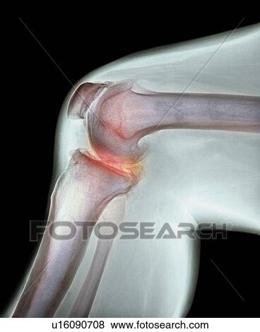 Stock Photo - Arthritis of the knee. Coloured X-ray the arthritic knee of a 37 year old man. The knee had previously been damaged in a motorbike accident.. Fotosearch