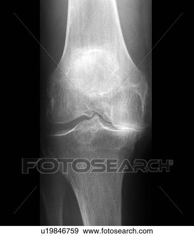 Stock Photo - Arthritis of the knee. Frontal X-ray showing the knee of a 59 year old patient with arthritis.. Fotosearch