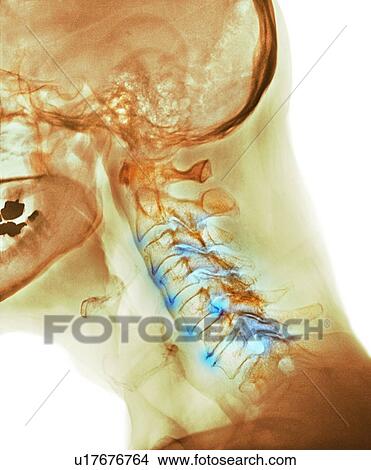 Picture - Arthritis of the neck. Coloured X-ray of the arthritic cervical spine of a 70 year old man.. Fotosearch
