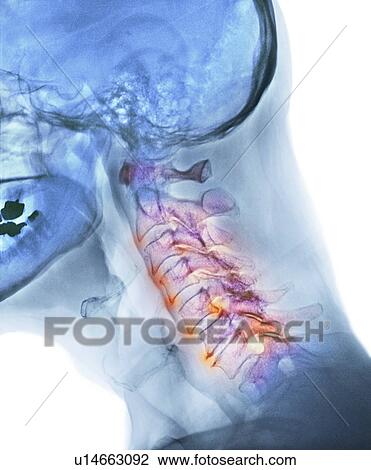 Stock Image - Arthritis of the neck. Coloured X-ray of the arthritic cervical spine of a 70 year old man.. Fotosearch