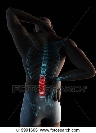 Stock Image - Back pain, conceptual computer artwork.. Fotosearch