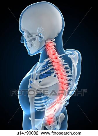 Stock Image - Back pain, conceptual computer artwork.. Fotosearch