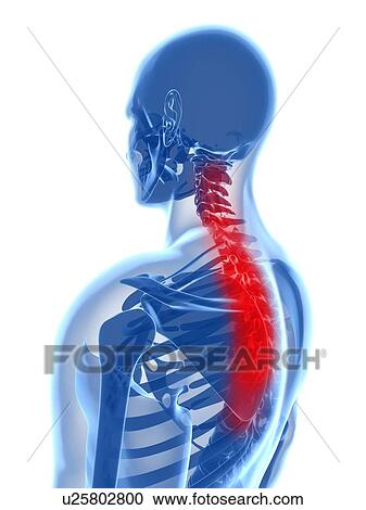 Stock Image - Back pain, conceptual computer artwork.. Fotosearch