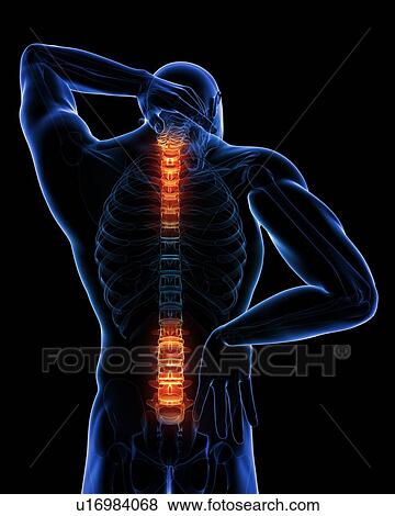 Stock Photo - Back pain, conceptual computer artwork.. Fotosearch