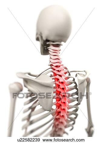 Stock Photo - Back pain, conceptual computer artwork.. Fotosearch