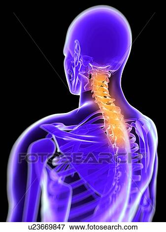 Stock Photo - Back pain, conceptual computer artwork.. Fotosearch
