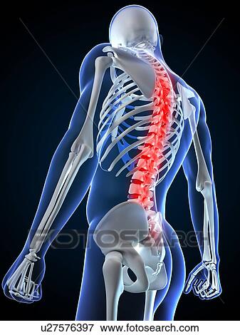 Stock Photo - Back pain, conceptual computer artwork.. Fotosearch