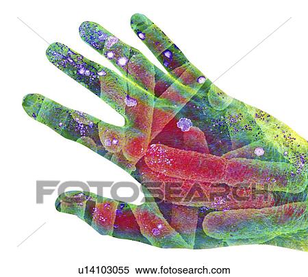 Stock Photography - Bacterial contamination. Conceptual computer artwork of a human hand contaminated with colonies of bacteria (blue pink patches) and rod-shaped E. coli. The lurid colours represent the danger posed by the bacteria. Hands come into contact with a wide varie. Fotosearch