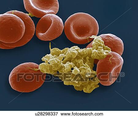 Blood cells. Coloured scanning electron micrograph (SEM) of red blood cells and an aggregate of platelets (yellow). Magnification: x4000 when printed at 10 centimetres wide. View Large Photo Image Stock Photo - Blood cells. Coloured scanning electron micrograph (SEM) of red blood cells and an aggregate of platelets (yellow). Magnification: x4000 when printed at 10 centimetres wide.. Fotosearch
