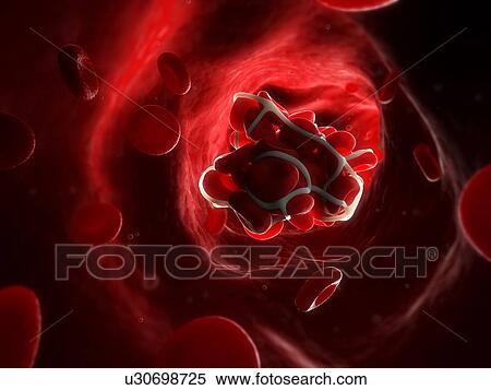 Blood clot. Computer artwork of red blood cells trapped in a fibrin protein mesh in an artery. View Large Photo Image Stock Photography - Blood clot. Computer artwork of red blood cells trapped in a fibrin protein mesh in an artery.. Fotosearch