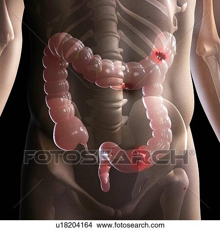 Picture - Bowel cancer, computer artwork.. Fotosearch