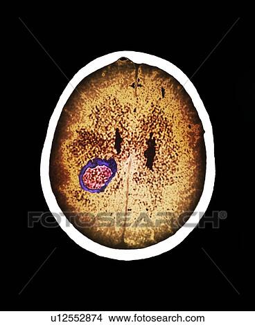 Picture - Brain abscess. Coloured computed tomography (CT) scan of an axial section through the brain of a 41 year old patient with a cerebral abscess. An abscess is a collection of pus in response to infection. The abscess has been highlighted by injected iodine.. Fotosearch