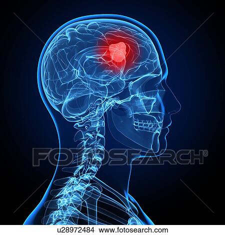 Brain cancer, computer artwork. View Large Photo Image Picture - Brain cancer, computer artwork.. Fotosearch