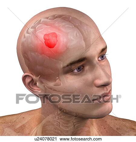 Brain cancer, computer artwork. View Large Photo Image Stock Image - Brain cancer, computer artwork.. Fotosearch