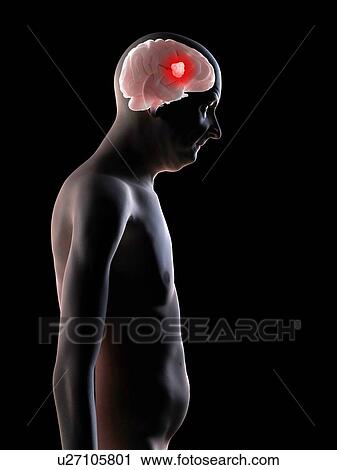 Brain cancer, computer artwork. View Large Photo Image Stock Image - Brain cancer, computer artwork.. Fotosearch