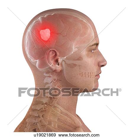 Brain cancer, computer artwork. View Large Photo Image Stock Photo - Brain cancer, computer artwork.. Fotosearch