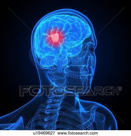 Stock Photo - Brain cancer, computer artwork.. Fotosearch