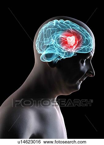 Stock Photograph - Brain cancer, computer artwork.. Fotosearch
