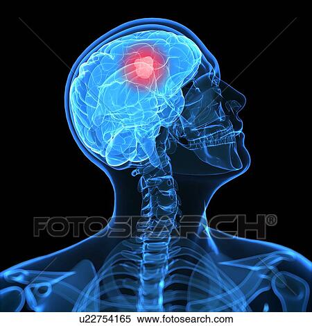 Brain cancer, computer artwork. View Large Photo Image Stock Photography - Brain cancer, computer artwork.. Fotosearch