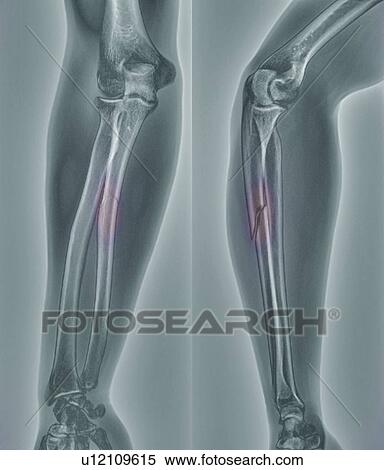 Stock Photography - Broken arm. X-ray of the arm of a 20 year old patient with a fractured radius (lower arm bone).. Fotosearch
