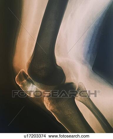 Picture - Broken knee. Coloured X-ray of the knee of a 38 year old patient with a fractured patella (kneecap).. Fotosearch