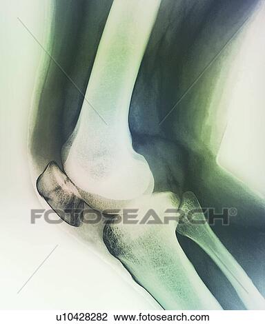 Stock Image - Broken knee. Coloured X-ray of the knee of a 38 year old patient with a fractured patella (kneecap).. Fotosearch