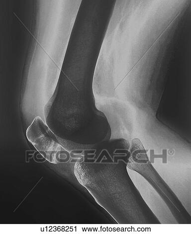 Stock Image - Broken knee. X-ray of the knee of a 38 year old patient with a fractured patella (kneecap).. Fotosearch