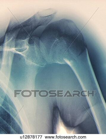 Stock Photo - Broken shoulder. Coloured X-ray of the shoulder of a patient with a fracture in the neck of the humerus (upper arm bone).. Fotosearch