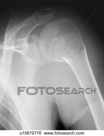 Broken shoulder. X-ray of the shoulder of a patient with a fracture in the neck of the humerus (upper arm bone). View Large Photo Image Stock Image - Broken shoulder. X-ray of the shoulder of a patient with a fracture in the neck of the humerus (upper arm bone).. Fotosearch