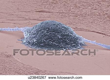 Cancer cell dividing. Coloured scanning electron micrograph (SEM) of a colorectal cancer cell dividing. It is in late telophase. Magnification: x4000 when printed at 10 centimetres wide. View Large Photo Image Stock Photo - Cancer cell dividing. Coloured scanning electron micrograph (SEM) of a colorectal cancer cell dividing. It is in late telophase. Magnification: x4000 when printed at 10 centimetres wide.. Fotosearch