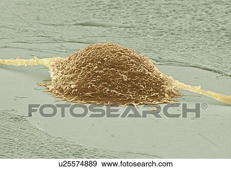 Stock Photo - Cancer cell dividing. Coloured scanning electron micrograph (SEM) of a colorectal cancer cell dividing. It is in late telophase. Magnification: x4000 when printed at 10 centimetres wide.. Fotosearch