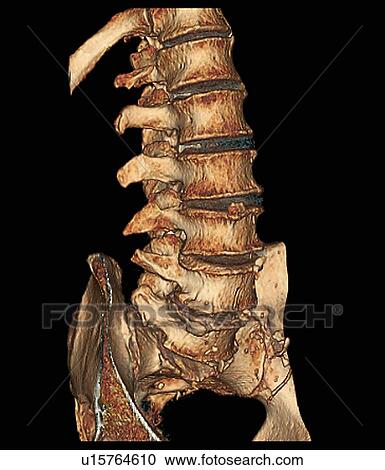 Degenerative disc disease. Coloured 3D computed tomography (CT) scan of the lumbosacral spine of a 74 year old patient with degenerative disc disease. The disc between the S1 and L5 vertebrae (bottom) has completely degenerated and the disc between L5 and View Large Photo Image Stock Image - Degenerative disc disease. Coloured 3D computed tomography (CT) scan of the lumbosacral spine of a 74 year old patient with degenerative disc disease. The disc between the S1 and L5 vertebrae (bottom) has completely degenerated and the disc between L5 and. Fotosearch