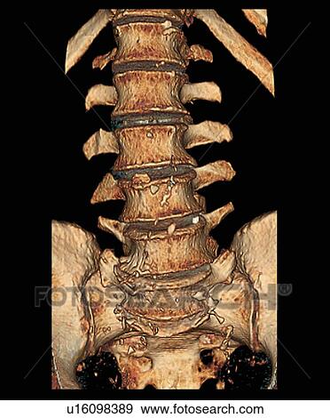 Degenerative disc disease. Coloured 3D computed tomography (CT) scan of the lumbosacral spine of a 74 year old patient with degenerative disc disease. The disc between the S1 and L5 vertebrae (bottom) has completely degenerated and the disc between L5 and View Large Photo Image Stock Photo - Degenerative disc disease. Coloured 3D computed tomography (CT) scan of the lumbosacral spine of a 74 year old patient with degenerative disc disease. The disc between the S1 and L5 vertebrae (bottom) has completely degenerated and the disc between L5 and. Fotosearch