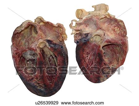 Stock Photo - Dissected human heart.. Fotosearch